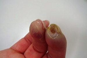 指先の循環障害による潰瘍