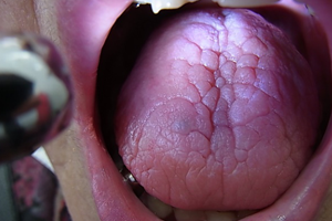 舌の静脈拡張