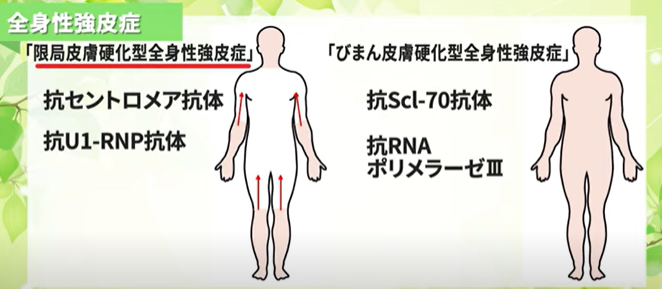 全身性強皮症とは